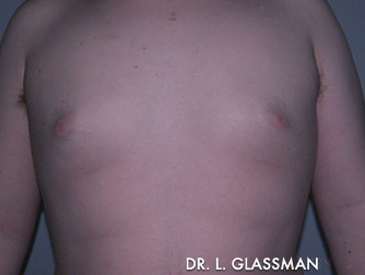 Gynecomastia (Male Breast Reduction) Case 3088 After Photo Gynecomastia (Male Breast Reduction)