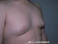 Gynecomastia (Male Breast Reduction)