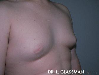 Gynecomastia (Male Breast Reduction) Case 3088 Before Photo Gynecomastia (Male Breast Reduction)