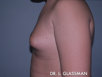 Gynecomastia (Male Breast Reduction) Case 3092 Before Photo Gynecomastia (Male Breast Reduction)
