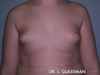 Gynecomastia (Male Breast Reduction) Case 3092 Before Photo Gynecomastia (Male Breast Reduction)