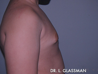 Gynecomastia (Male Breast Reduction)