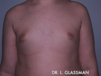 Gynecomastia (Male Breast Reduction)