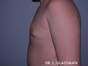 Gynecomastia (Male Breast Reduction) Case 3092 After Photo Gynecomastia (Male Breast Reduction)