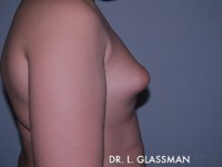 Gynecomastia (Male Breast Reduction)