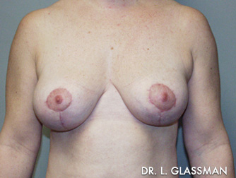 Mastopexy Case 3096 After Photo Mastopexy