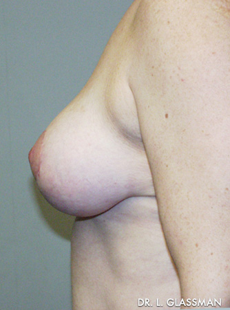 Mastopexy Case 3096 After Photo Mastopexy