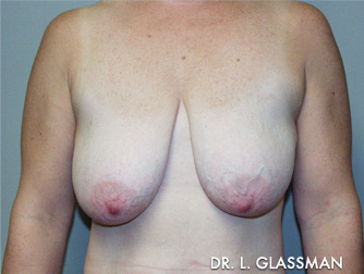 Mastopexy Case 3096 Before Photo Mastopexy