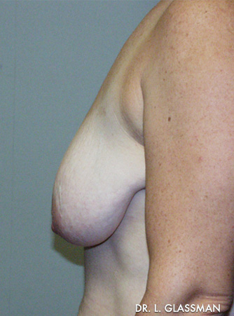 Mastopexy Case 3096 Before Photo Mastopexy