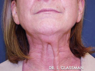 Facelift Case 3104 Before Photo Facelift