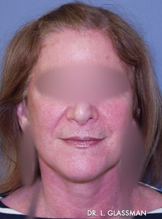 Facelift Case 3104 After Photo Facelift