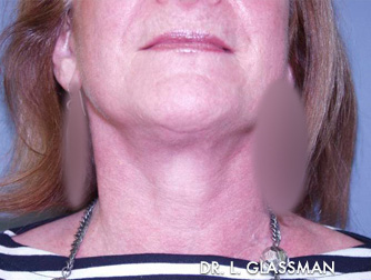 Facelift Case 3104 After Photo Facelift