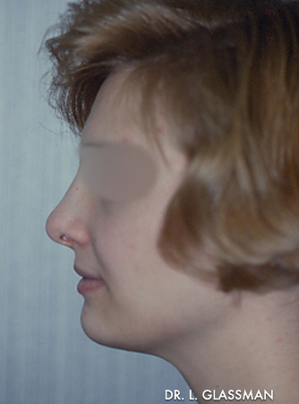 Rhinoplasty Case 3116 After Photo Rhinoplasty