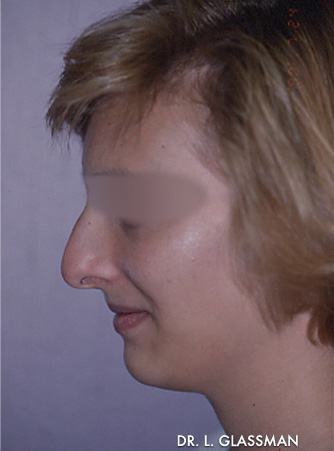 Rhinoplasty Case 3116 Before Photo Rhinoplasty