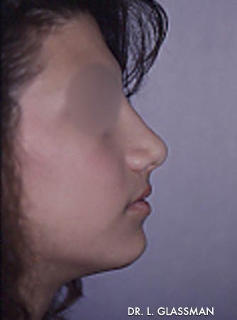 Rhinoplasty Case 3124 After Photo Rhinoplasty