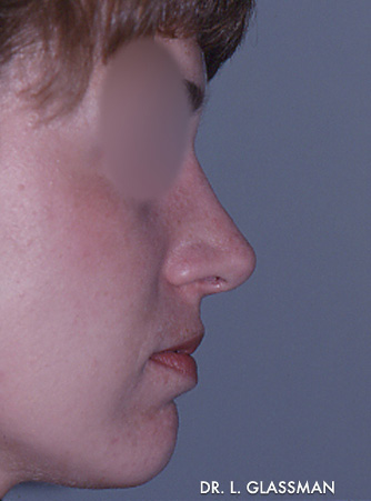 Rhinoplasty Case 3128 After Photo Rhinoplasty