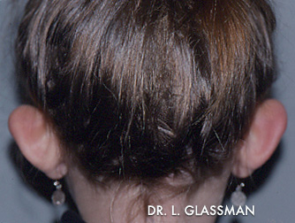 Otoplasty Case 3140 Before Photo Otoplasty