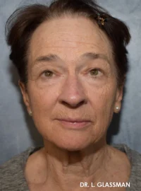 Facelift