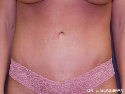 Abdominoplasty