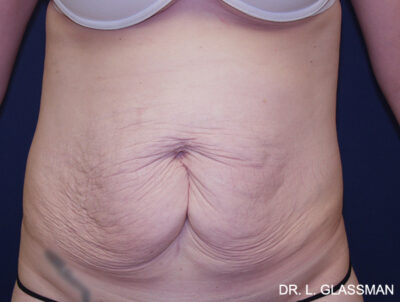 Abdominoplasty
