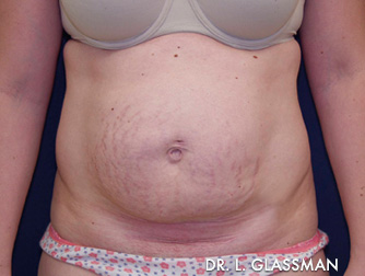 Abdominoplasty Before and After New York