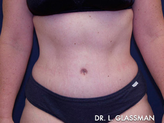 Abdominoplasty Before and After Results New York