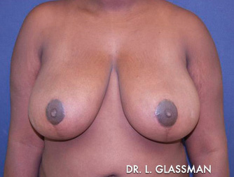 Breast Reduction Before and After Results