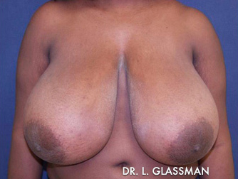 Breast Reduction Before and After Results